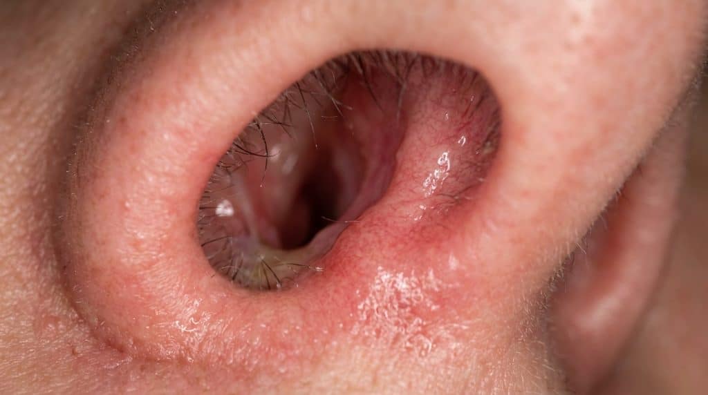 découvrez les causes de la vestibulite nasale, une inflammation de l'intérieur du nez, et apprenez comment soulager cette douleur gênante.